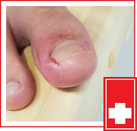 Nail Surgery in Durham - Effective treatment for ingrown toenails