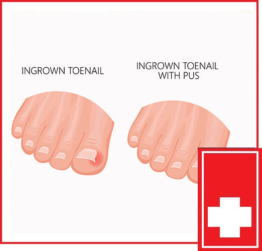 Ingrown Toenail Wilmington Urgent Care And Family Clinic